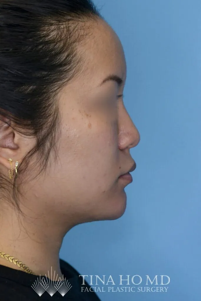Patient's lateral view after chin augmentation, jawline contouring, and facial injectable procedure