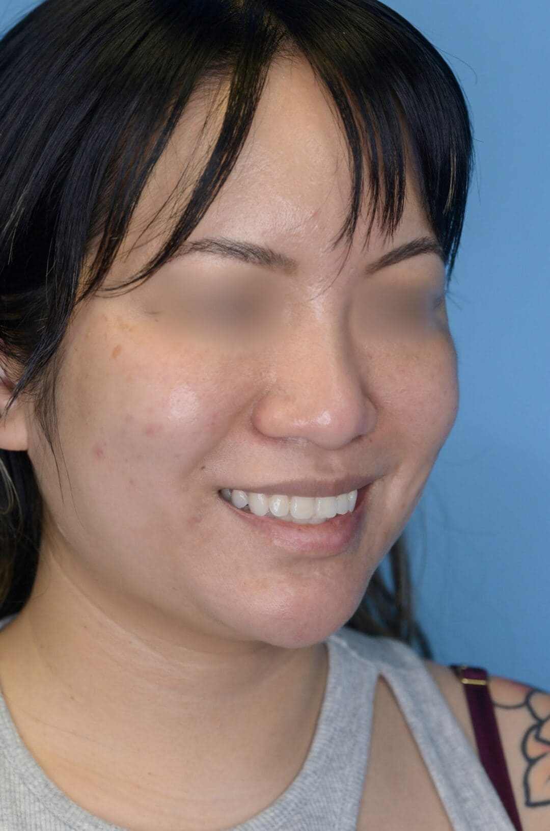 Patient's right oblique view before chin augmentation, jawline contouring, and facial injectable procedure