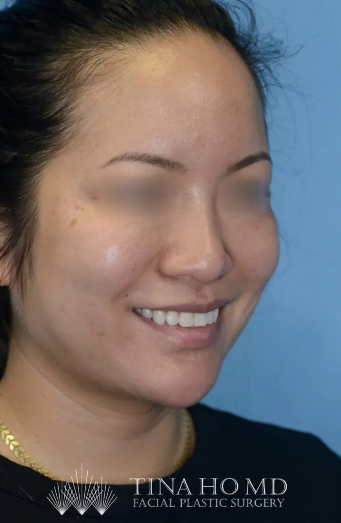 Patient's right oblique view after chin augmentation, jawline contouring, and facial injectable procedure