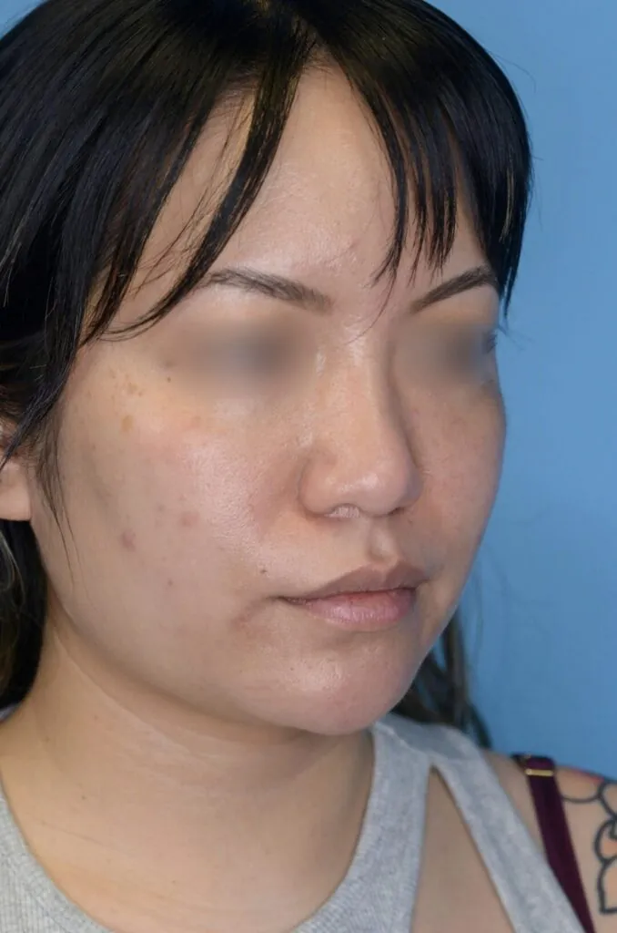 Patient's right oblique view before chin augmentation, jawline contouring, and facial injectable procedure
