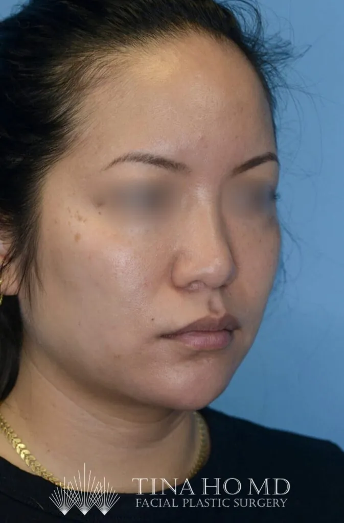 Patient's right oblique view after chin augmentation, jawline contouring, and facial injectable procedure