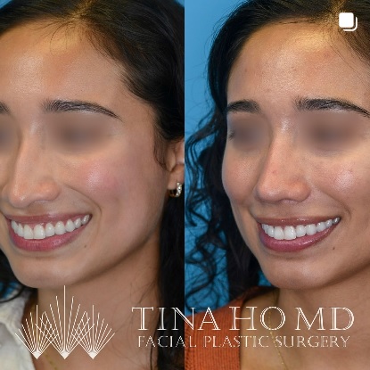 Rhinoplasty Patient Before and After