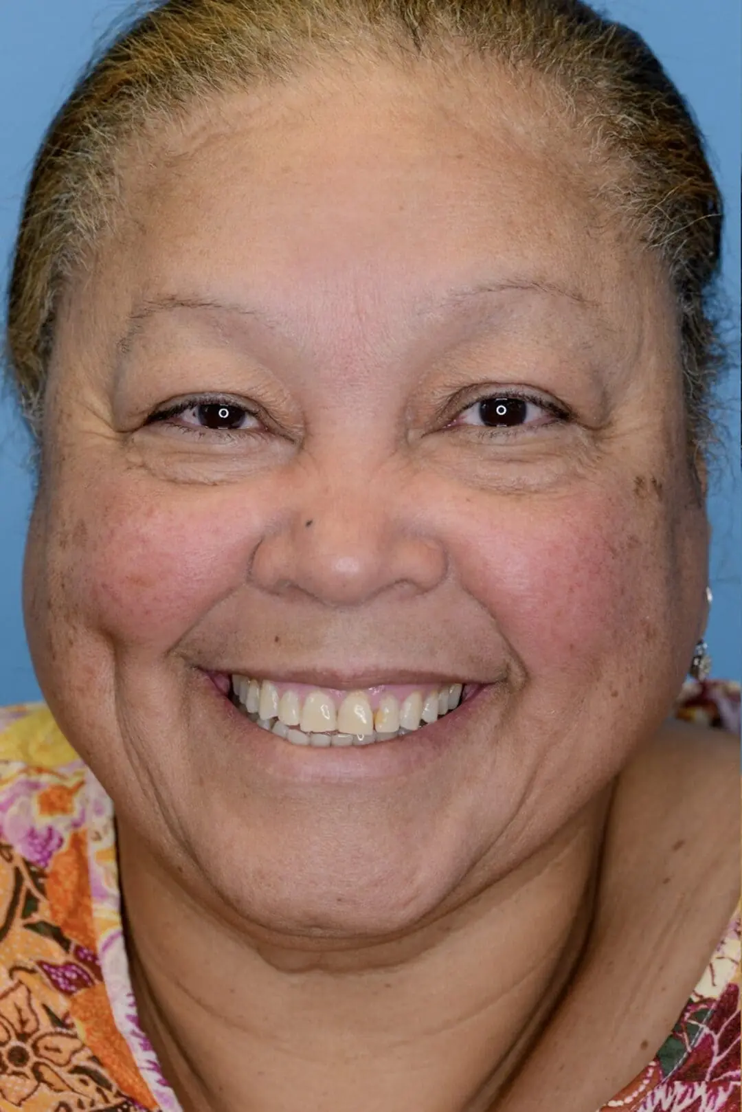 Patient RB facing forward before upper blepharoplasty in Philadelphia