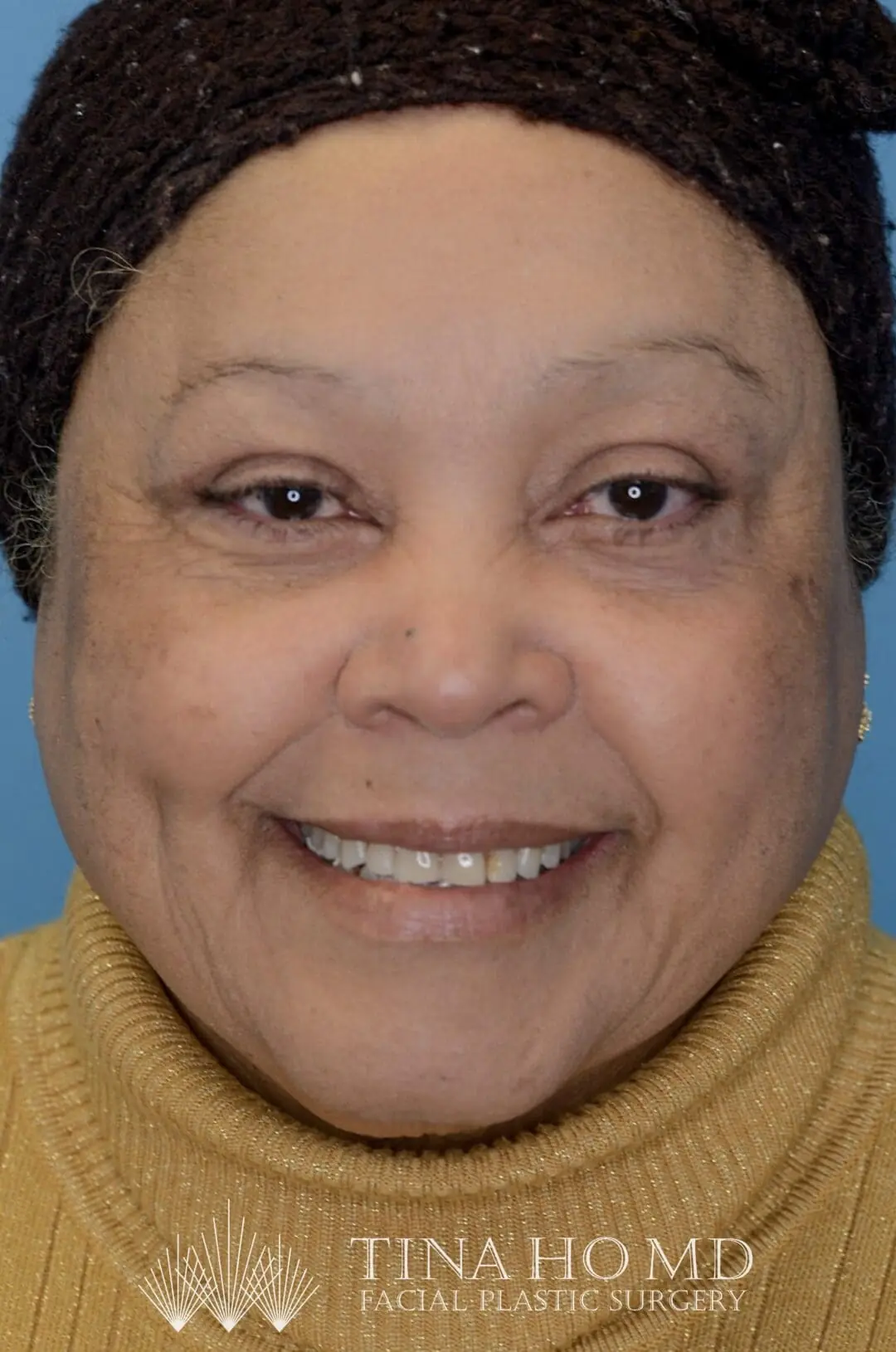 Patient RB facing forward after upper blepharoplasty in Philadelphia