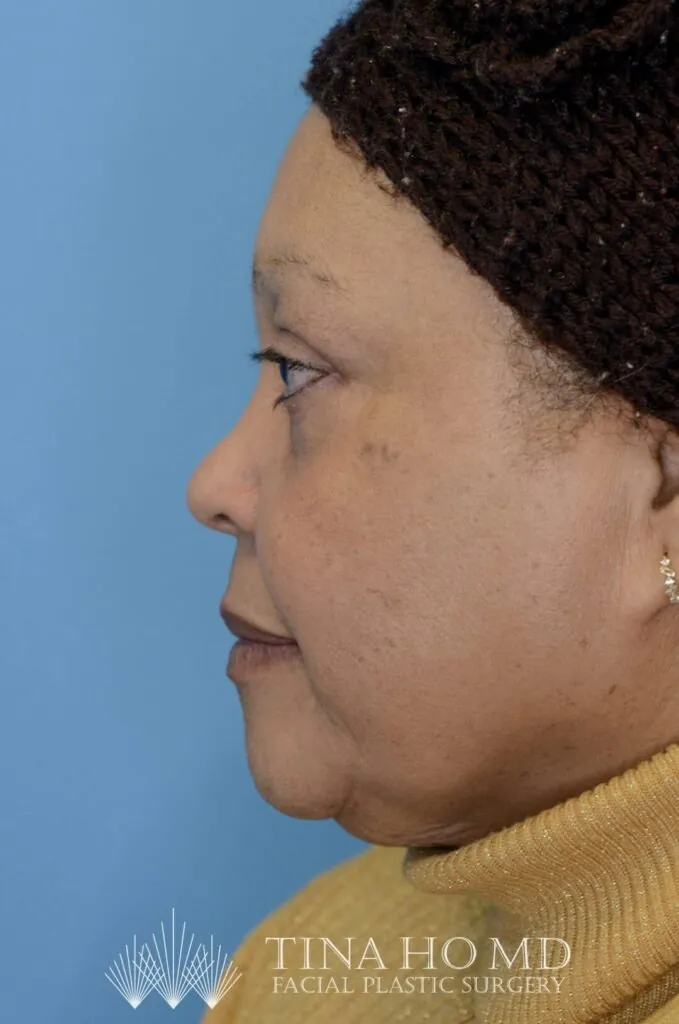 Patient RB left lateral view after upper blepharoplasty in Philadelphia