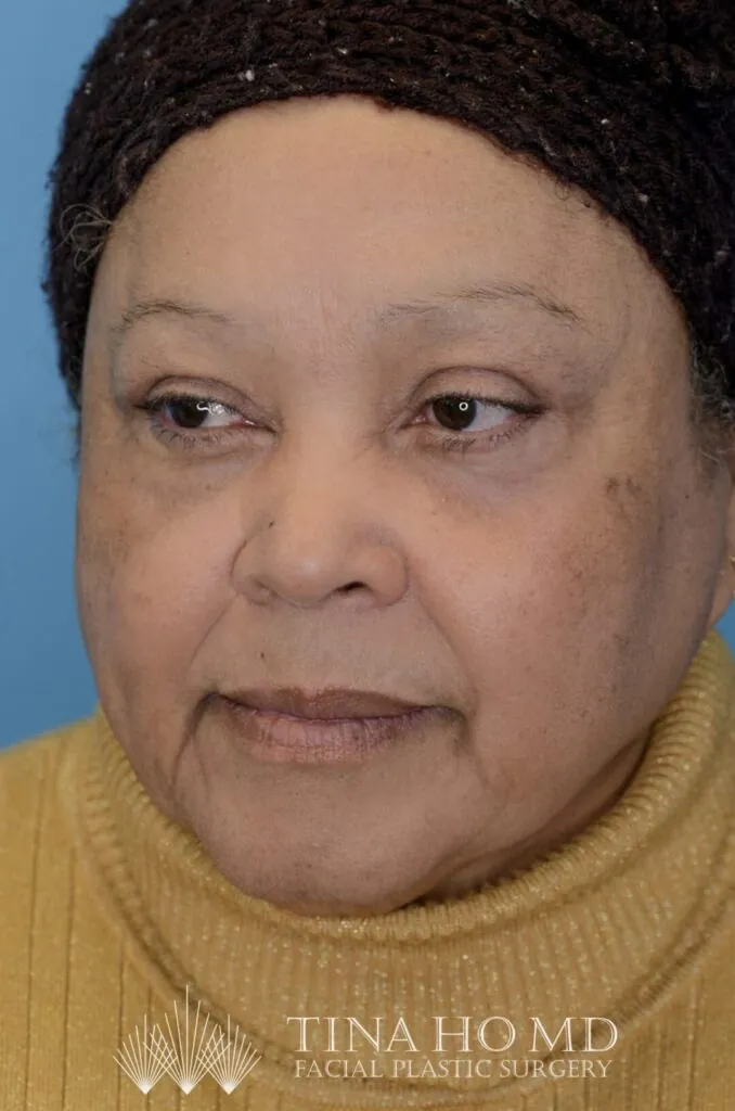 Patient RB left oblique view after upper blepharoplasty in Philadelphia