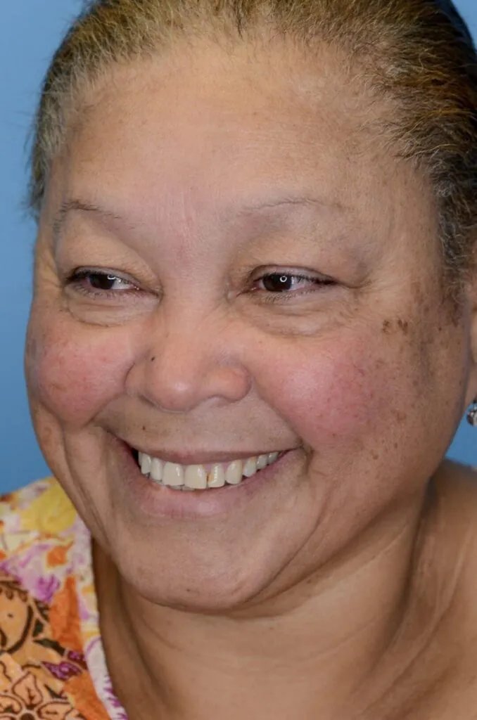 Patient RB left oblique view before upper blepharoplasty in Philadelphia