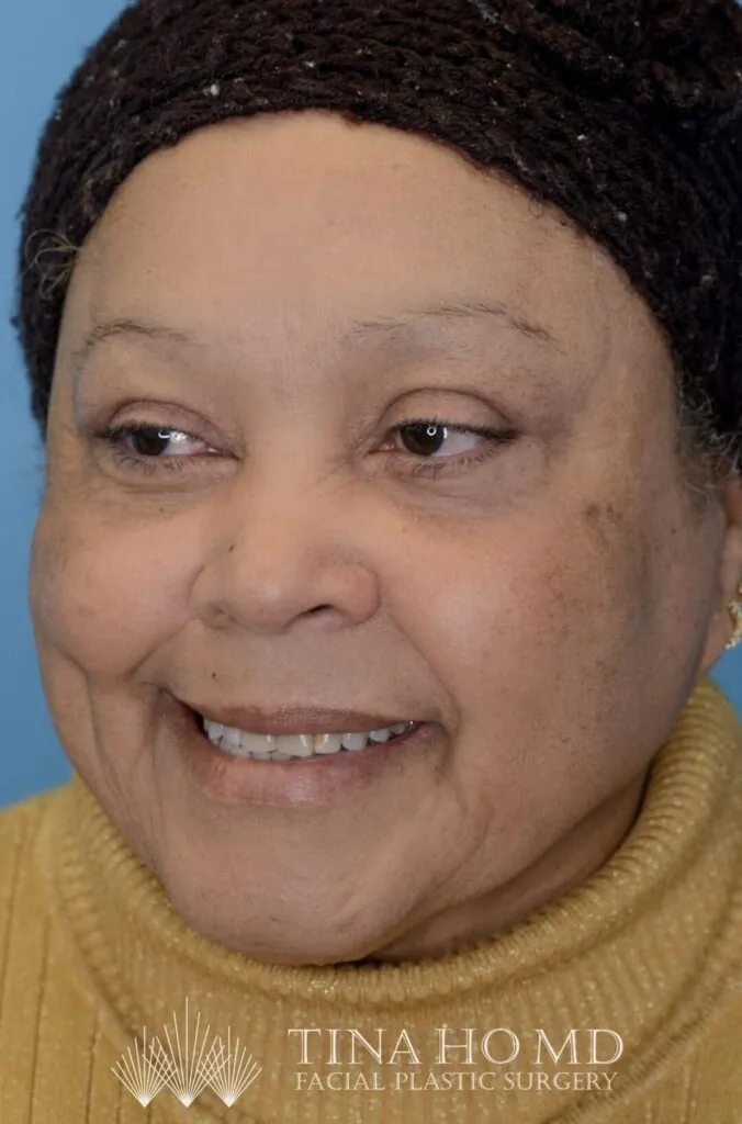 Patient RB left oblique view after upper blepharoplasty in Philadelphia