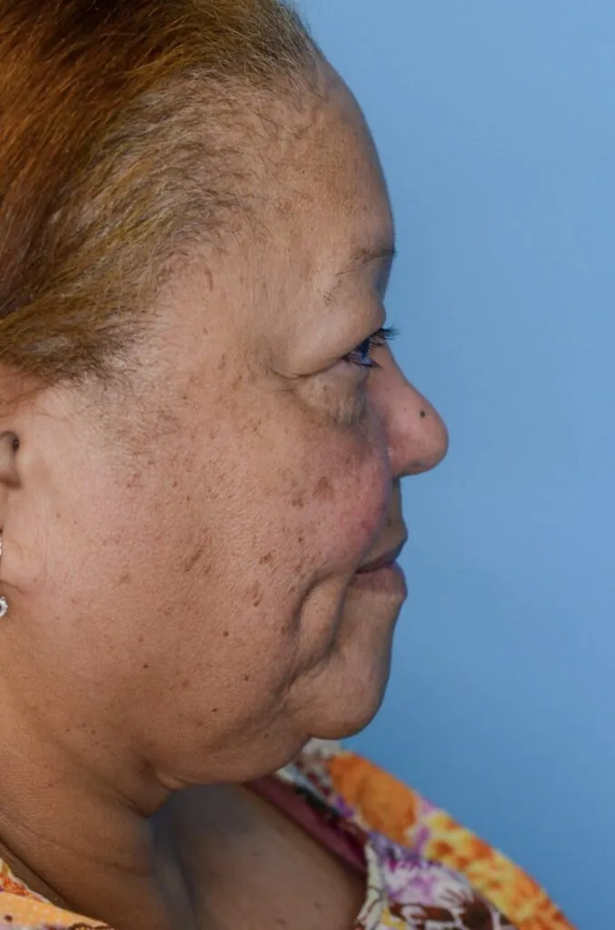 Patient RB right lateral view before upper blepharoplasty in Philadelphia
