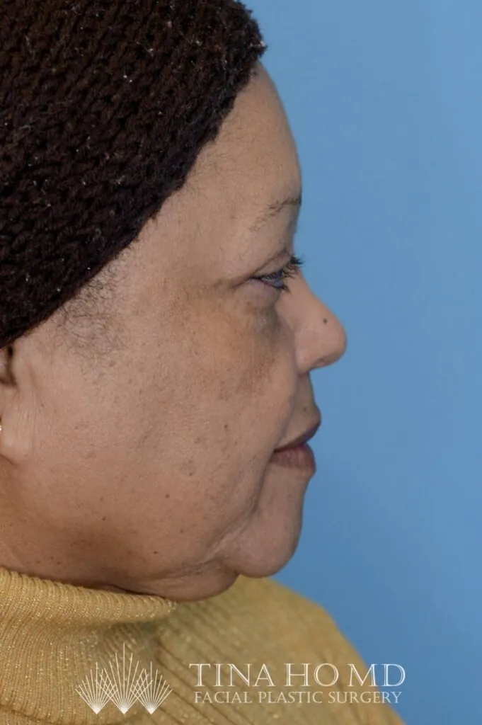 Patient RB right lateral view after upper blepharoplasty in Philadelphia