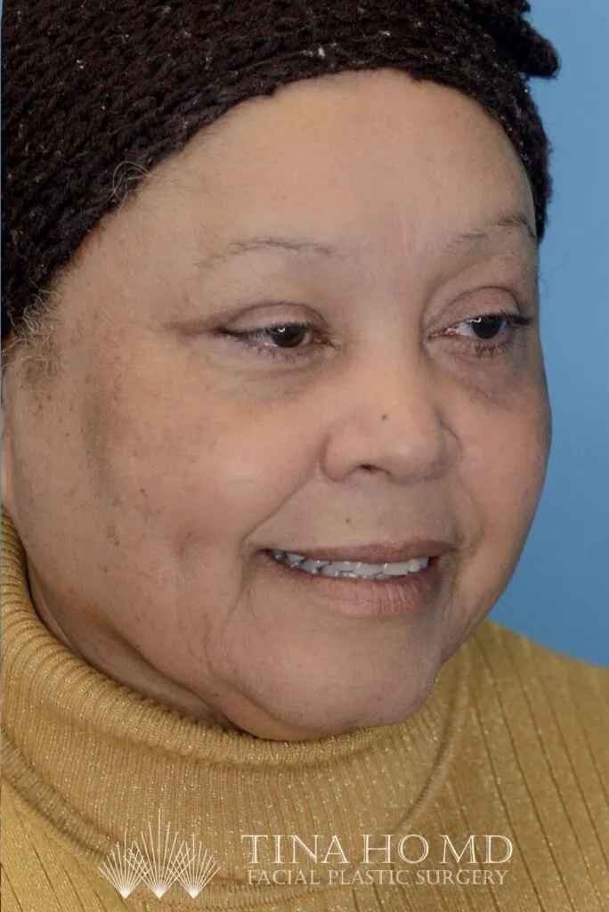 Patient RB right oblique view after upper blepharoplasty in Philadelphia