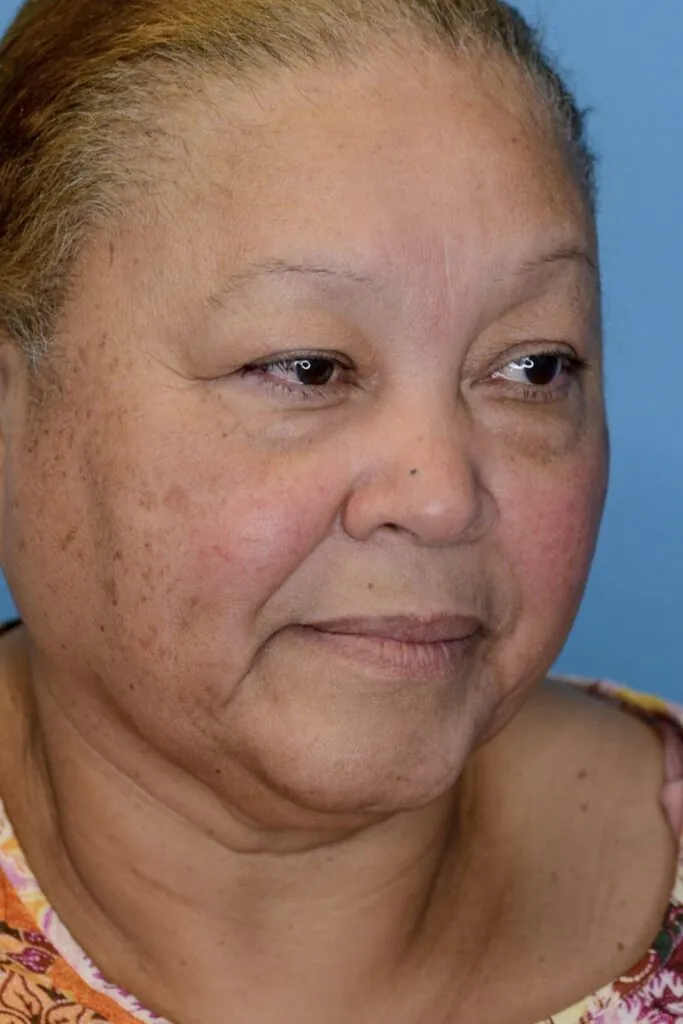 Patient RB right oblique view before upper blepharoplasty in Philadelphia