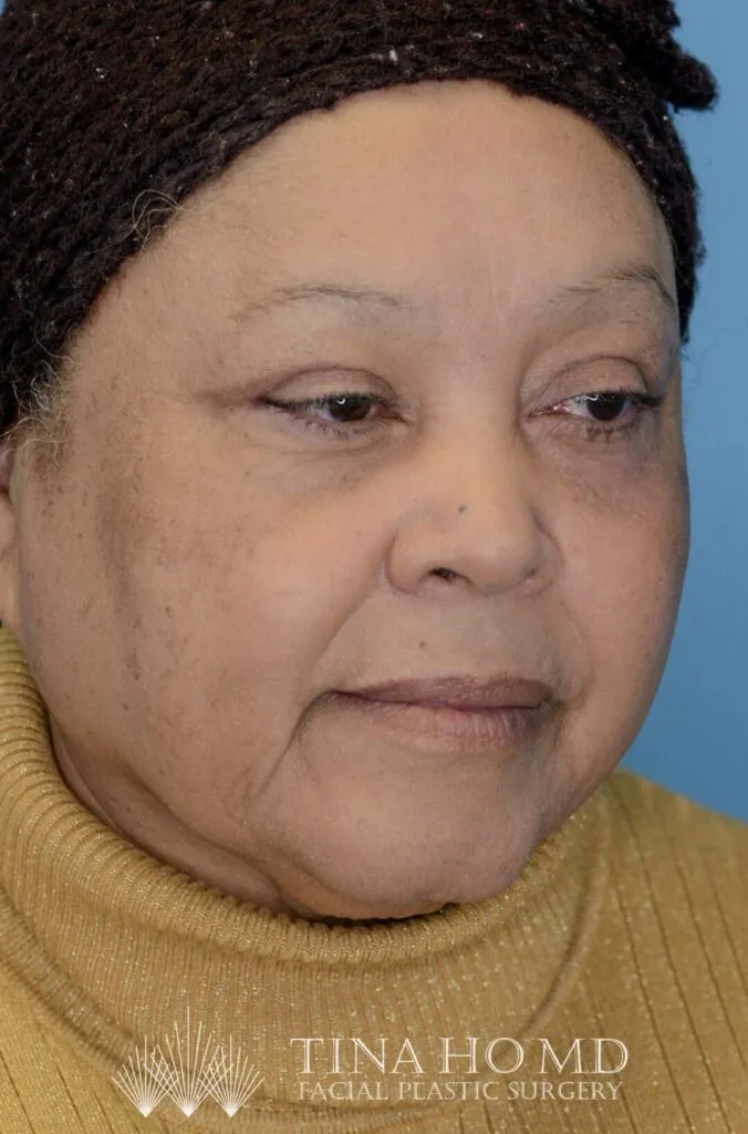 Patient RB right oblique view after upper blepharoplasty in Philadelphia