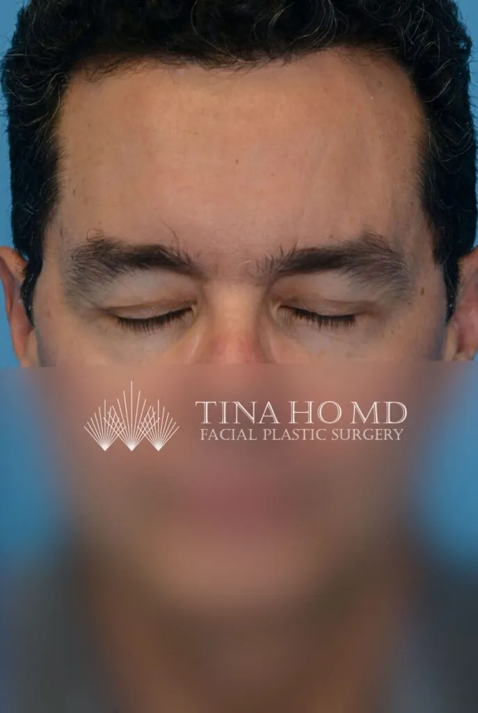 Patient's frontal facial view demonstrating upper blepharoplasty and brow lift results