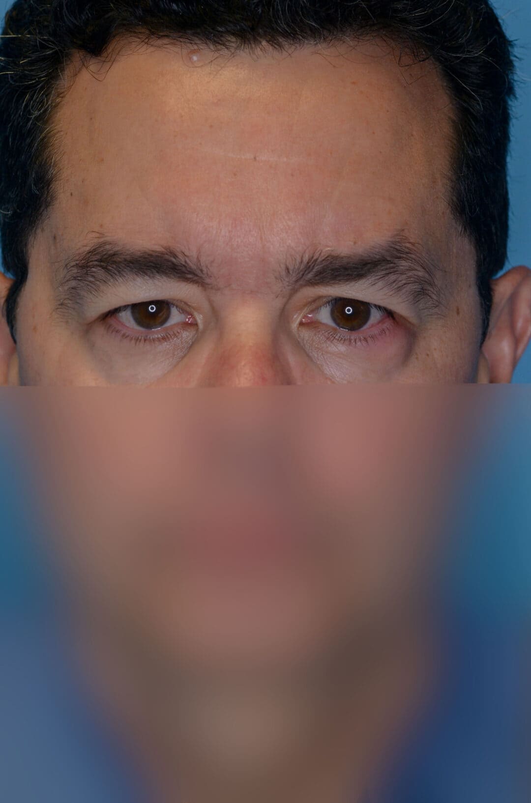 Patient's frontal facial view for upper blepharoplasty and brow lift evaluation in Philadelphia