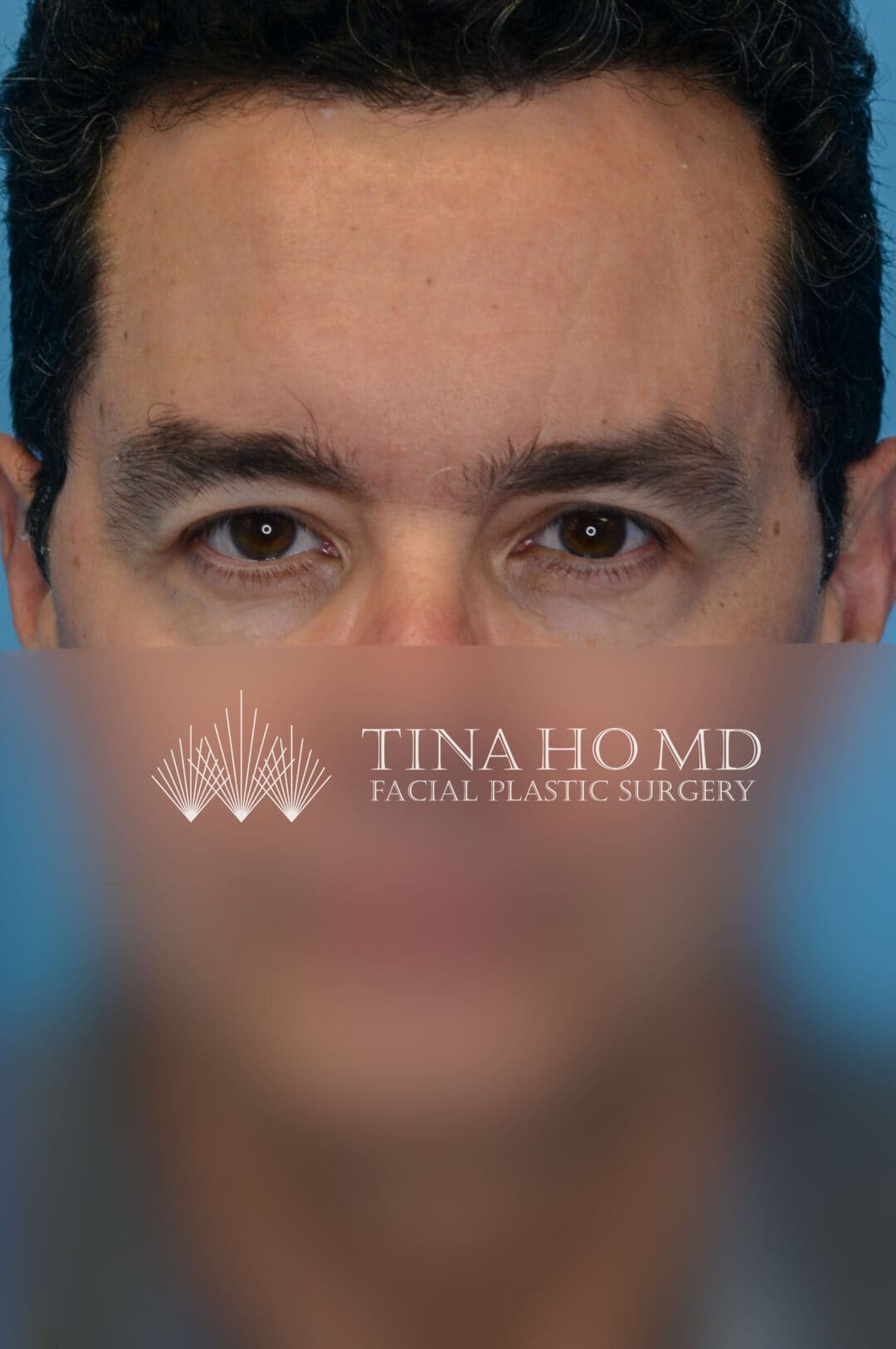 Patient BG facing forward after upper blepharoplasty and brow lift in Philadelphia