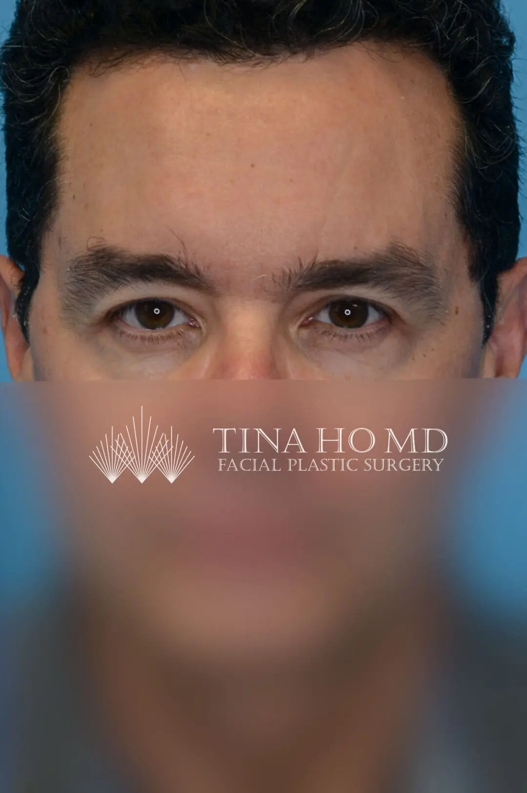 Patient BG facing forward after upper blepharoplasty and brow lift in Philadelphia