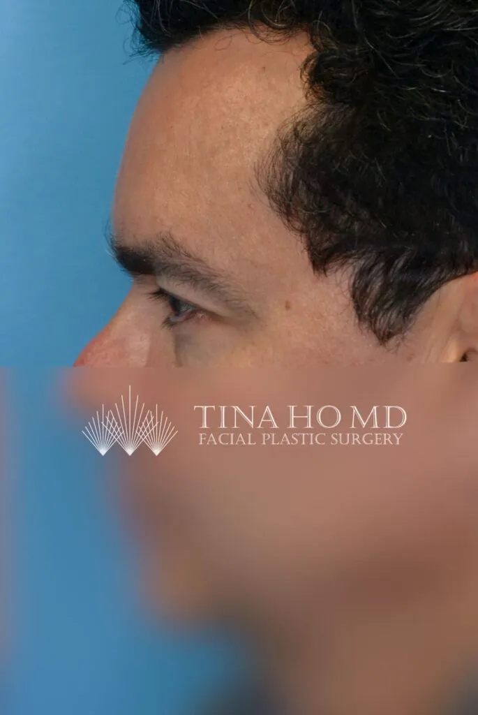 Patient BG left lateral view after upper blepharoplasty and brow lift in Philadelphia