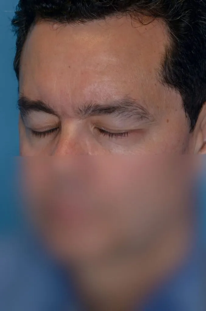 Patient BG left oblique view before upper blepharoplasty and brow lift in Philadelphia