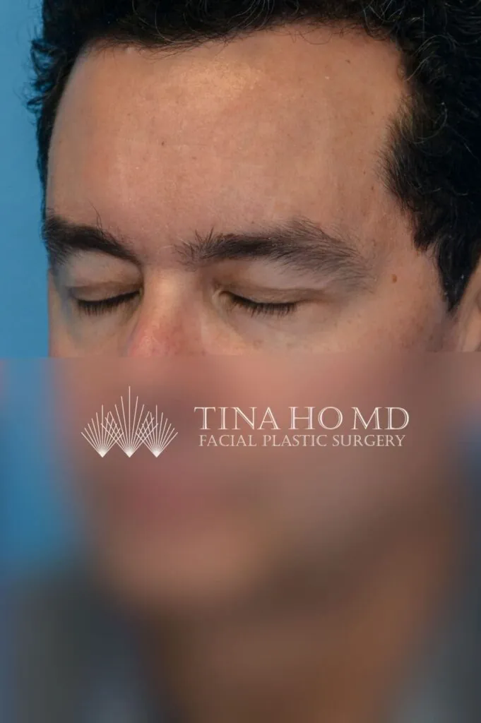 Patient BG left oblique view after upper blepharoplasty and brow lift in Philadelphia