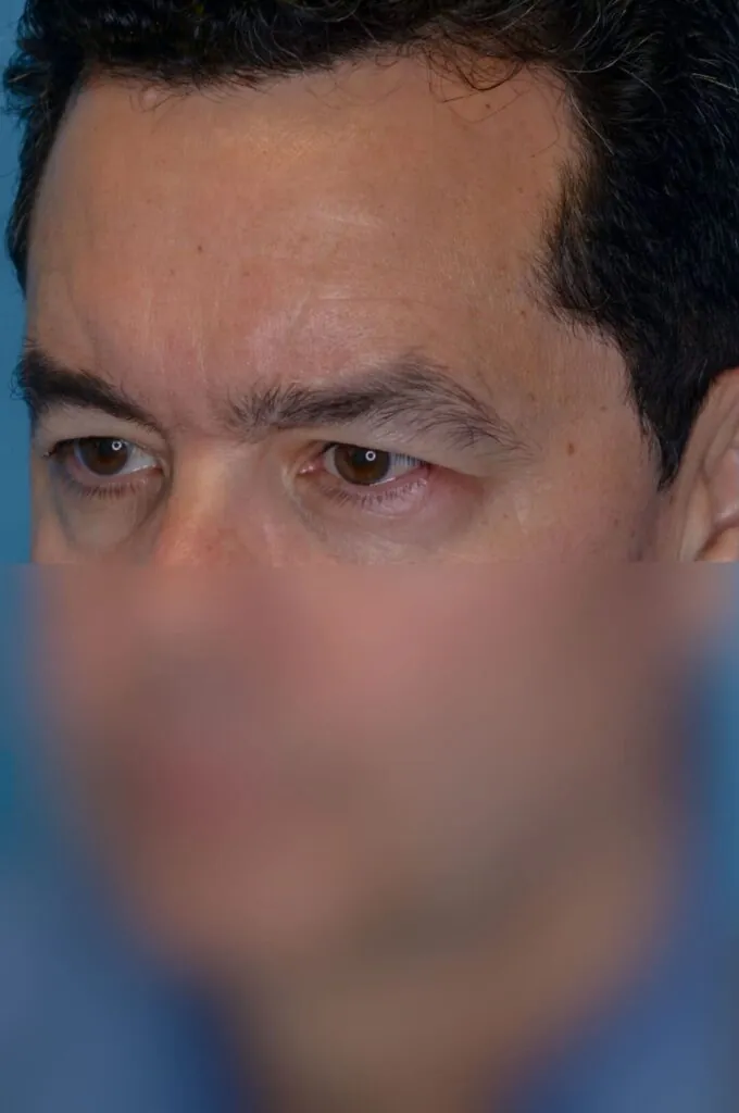 Patient BG left oblique view before upper blepharoplasty and brow lift in Philadelphia