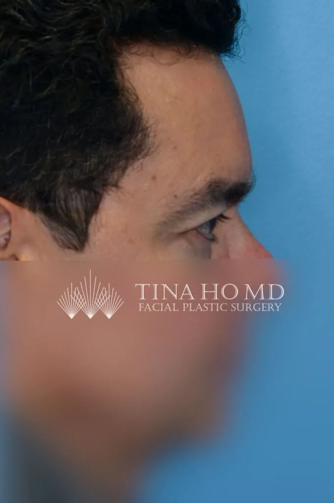 Patient BG left oblique view after upper blepharoplasty and brow lift surgery in Philadelphia