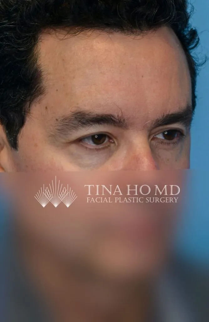 Patient BG right oblique view after upper blepharoplasty and brow lift surgery in Philadelphia