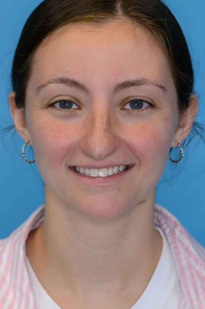 Patient HM's second frontal view before rhinoplasty surgery