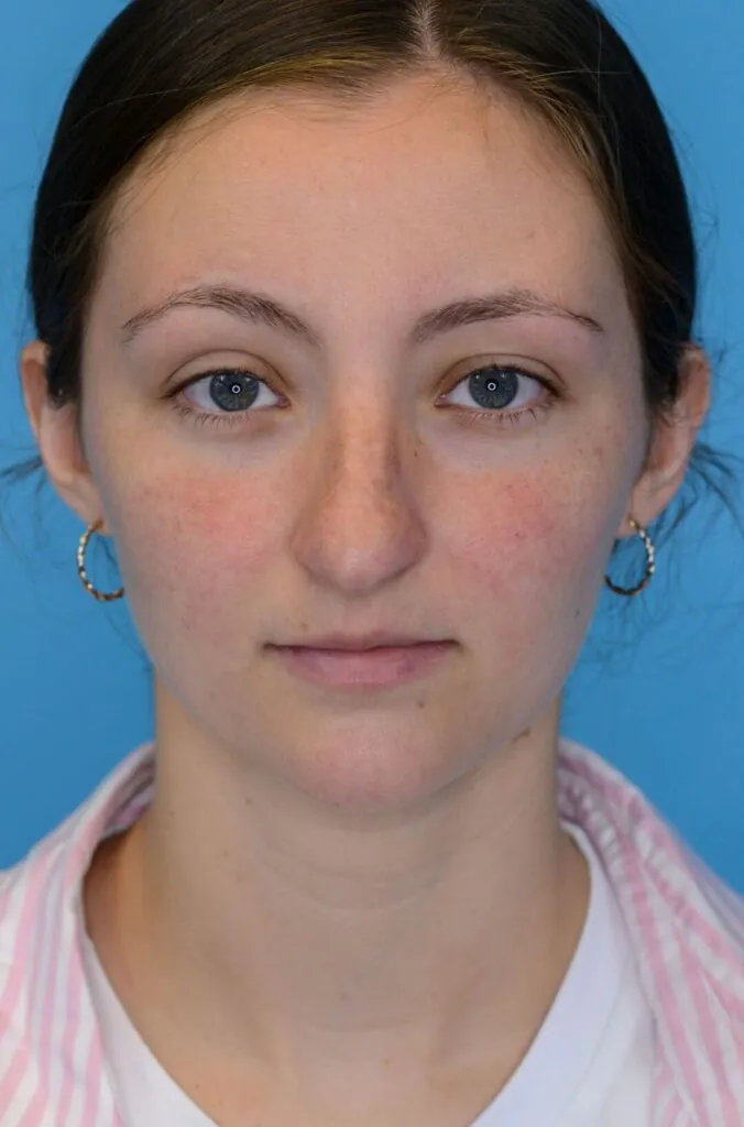 Patient HM's frontal view before rhinoplasty surgery