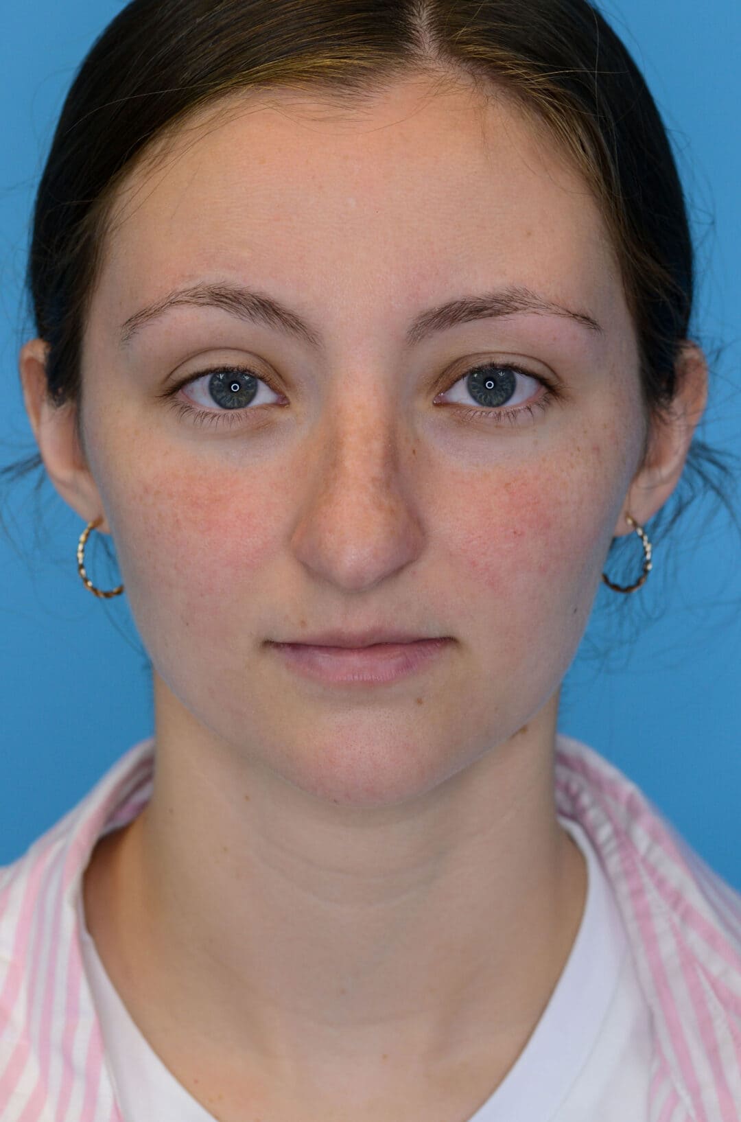 Patient HM's frontal view before rhinoplasty surgery