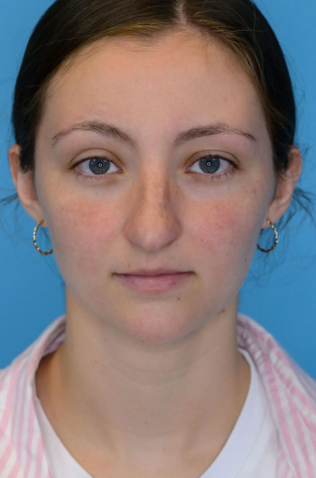 Patient HM's frontal view before rhinoplasty surgery