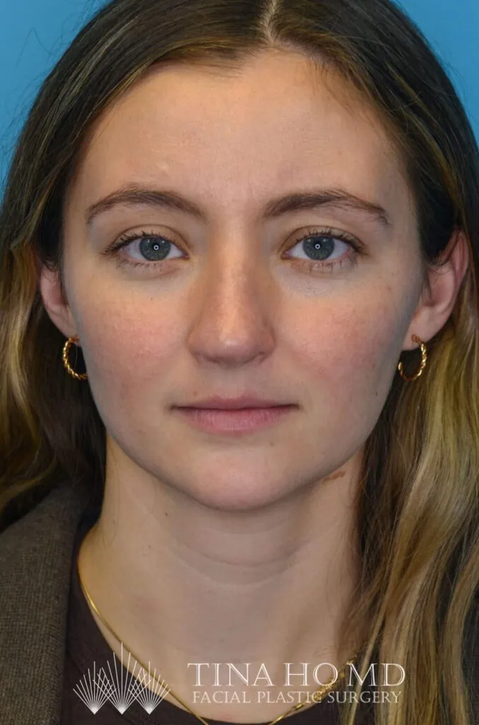 Patient HM's improved frontal view after rhinoplasty surgery