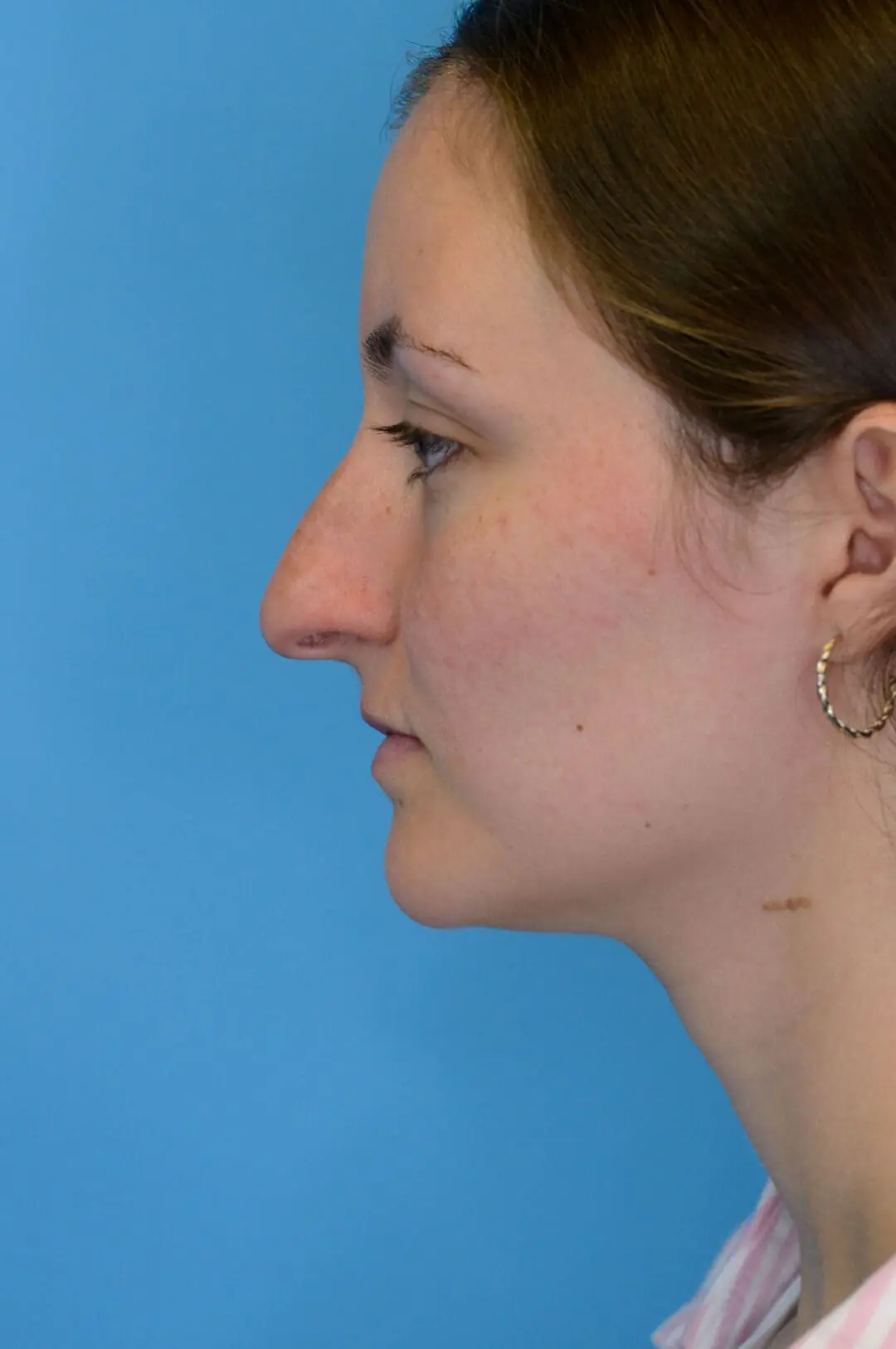 Patient HM's left lateral profile before rhinoplasty surgery