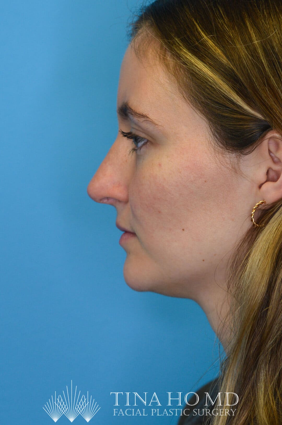 Patient HM's improved left lateral profile after rhinoplasty