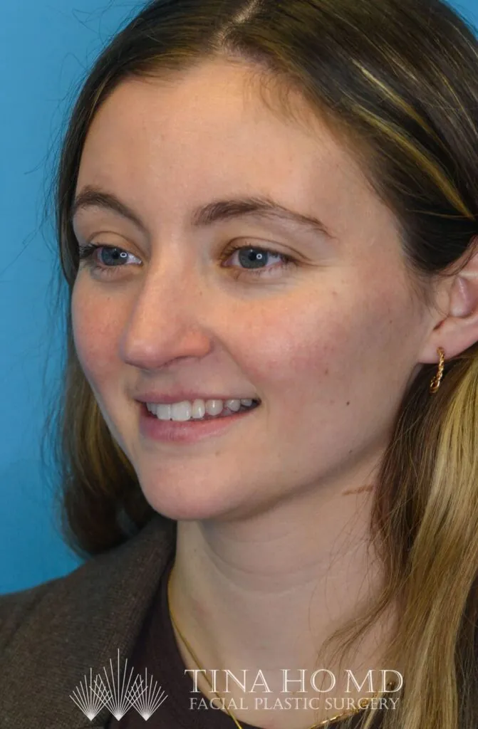 Patient HM's improved second left oblique view after rhinoplasty