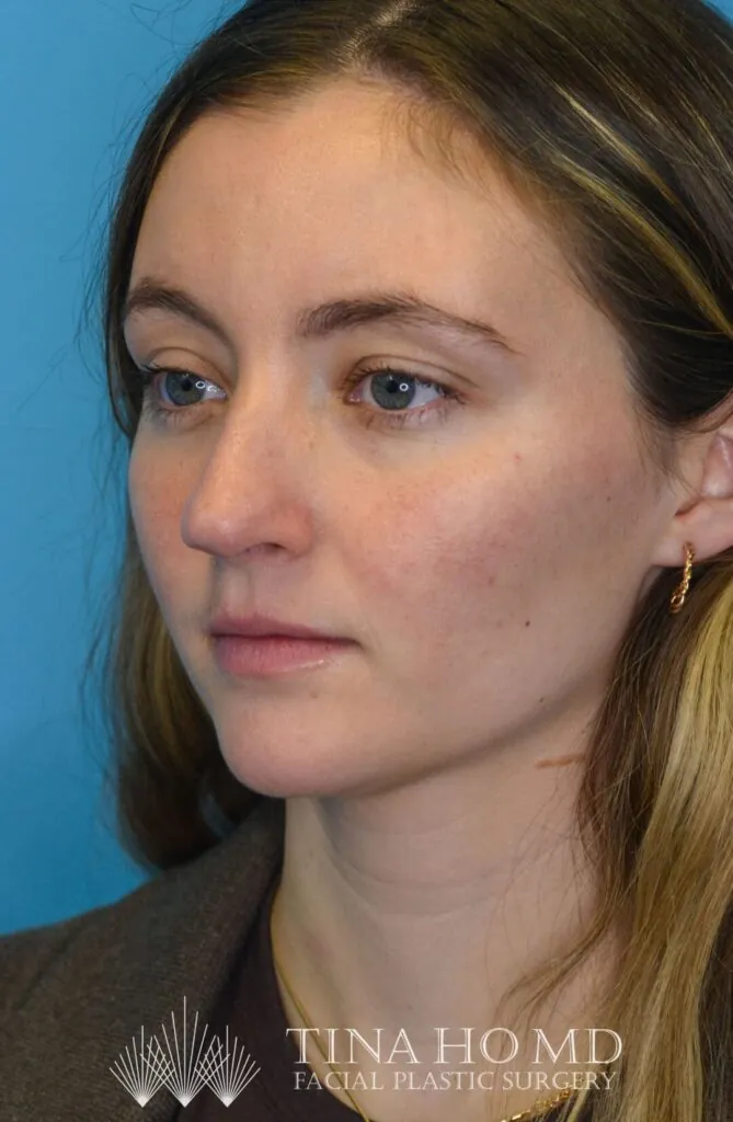 Patient HM's improved left oblique view after rhinoplasty