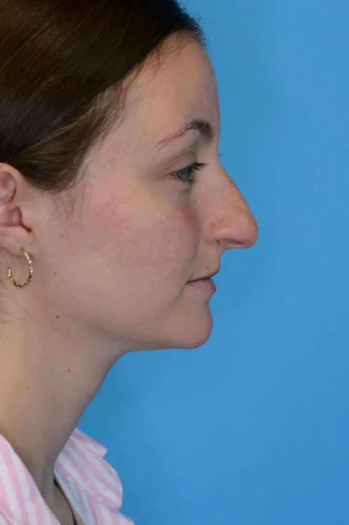 Patient HM's right lateral profile before rhinoplasty surgery