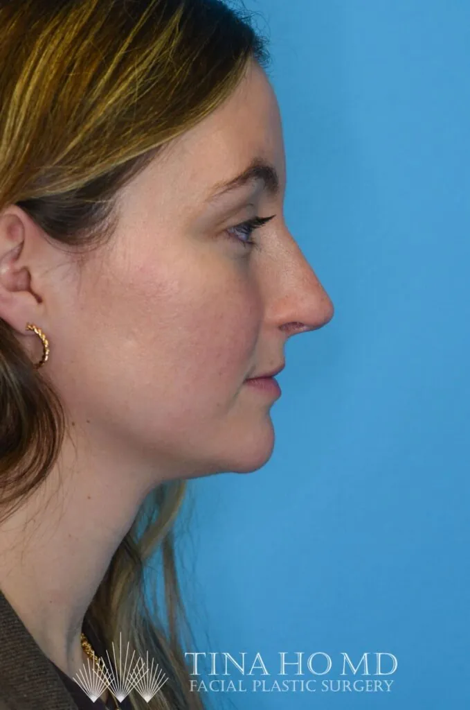 Patient HM's improved right lateral profile after rhinoplasty