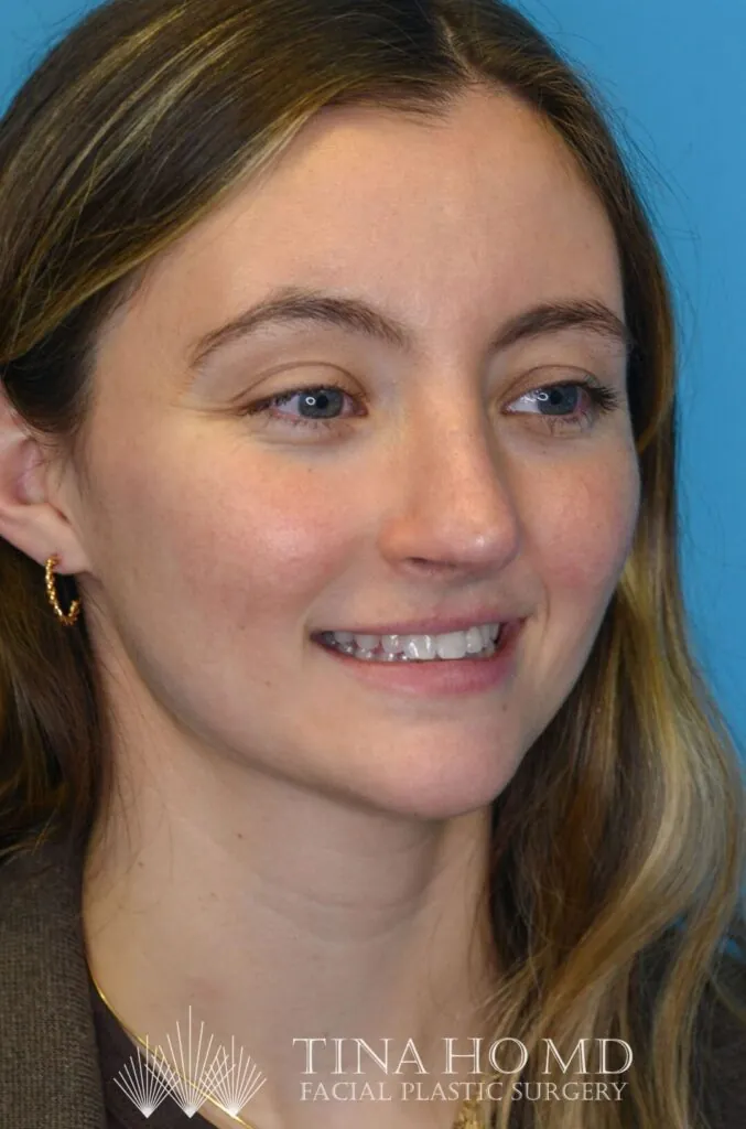 Patient HM's improved second right oblique view after rhinoplasty