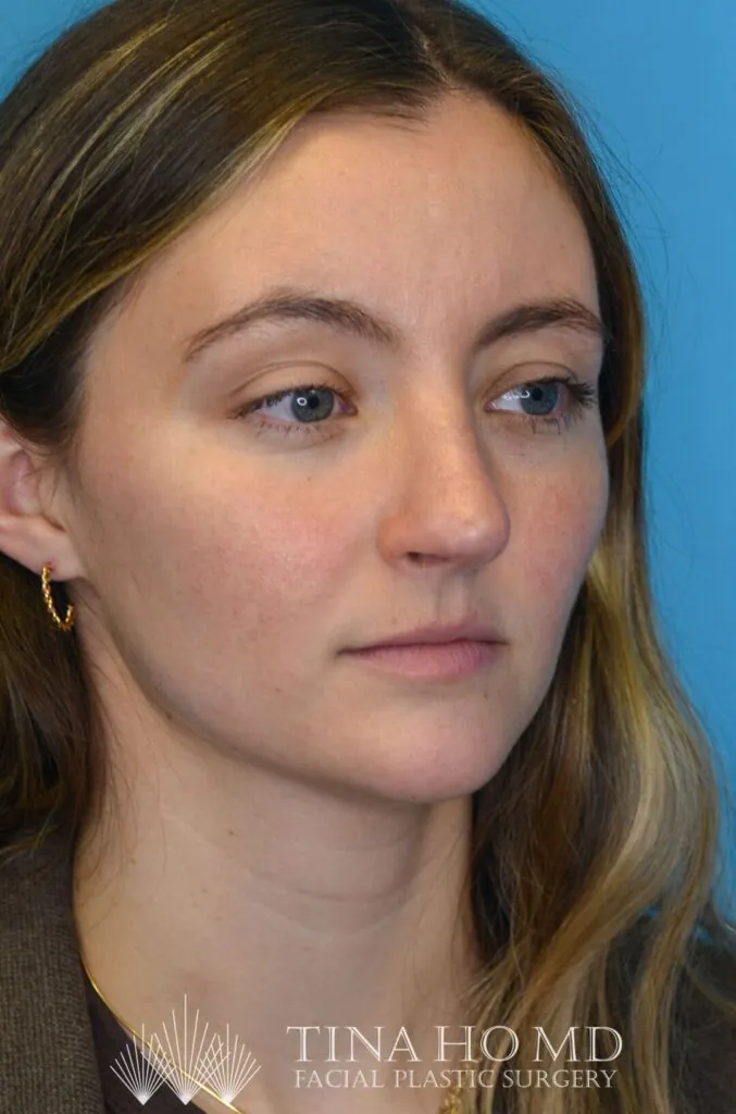 Patient HM's improved right oblique view after rhinoplasty