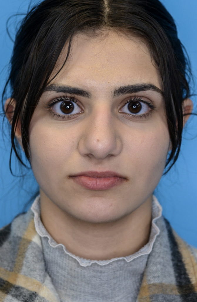 Patient KA's frontal profile one year after rhinoplasty