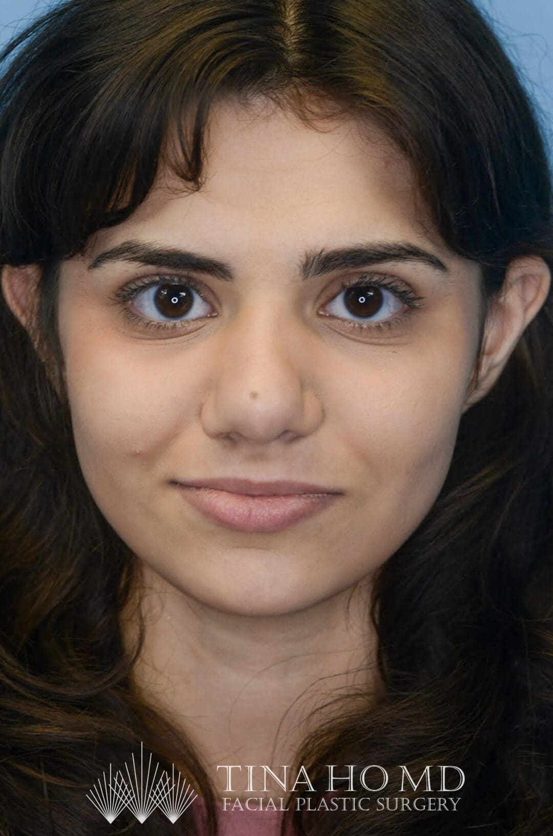 Patient KA's frontal profile one year after rhinoplasty, alternate view
