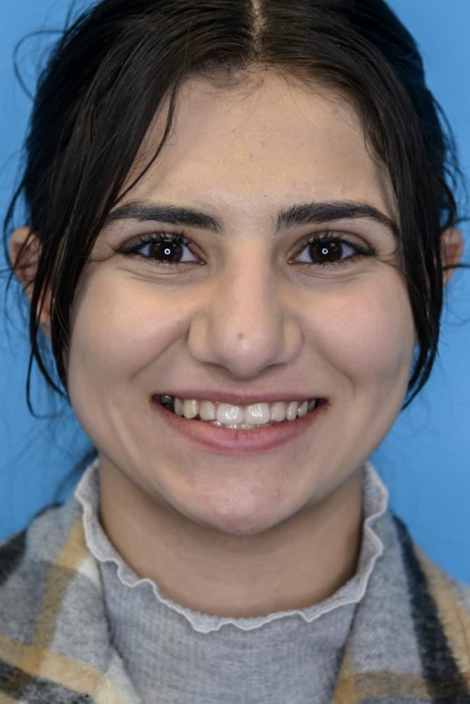 Patient KA's second frontal view one year after rhinoplasty