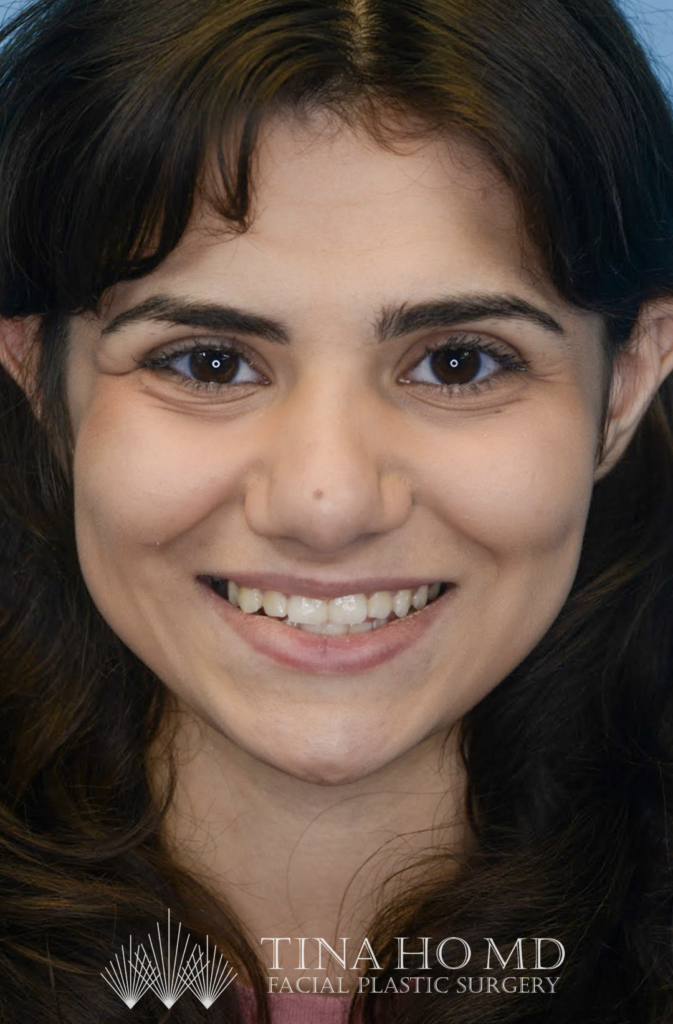 Patient KA's second frontal view one year after rhinoplasty, alternate view