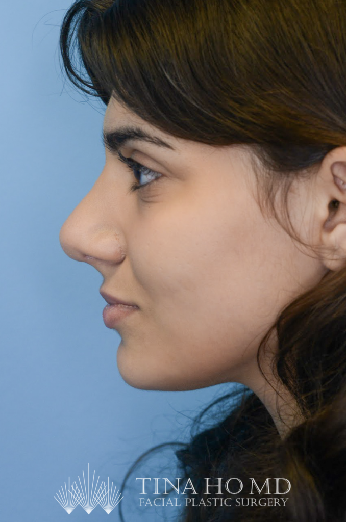 Patient KA's left lateral profile one year after rhinoplasty, alternate view