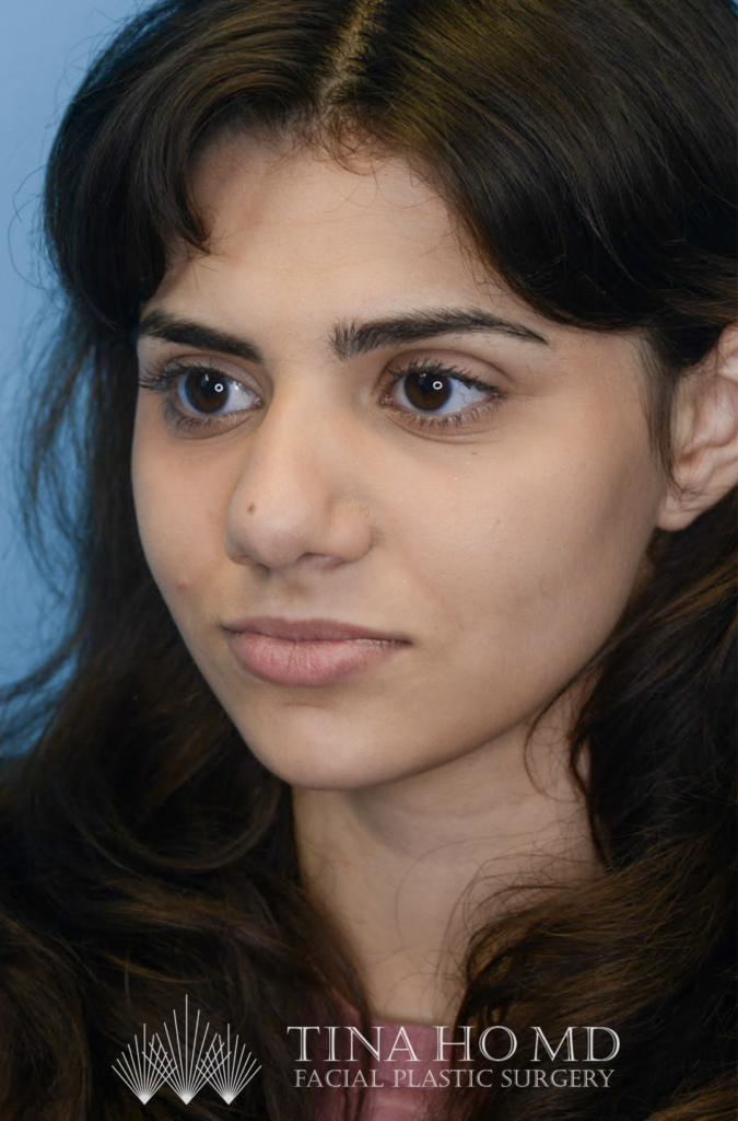 Patient KA's left oblique view one year after rhinoplasty, alternate view
