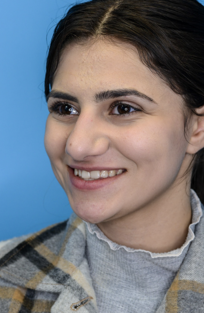 Patient KA's second left oblique view one year after rhinoplasty