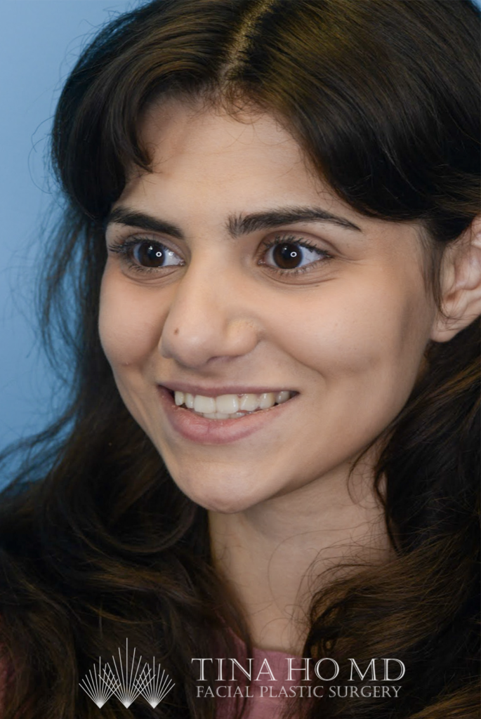 Patient KA's second left oblique view one year after rhinoplasty, alternate view