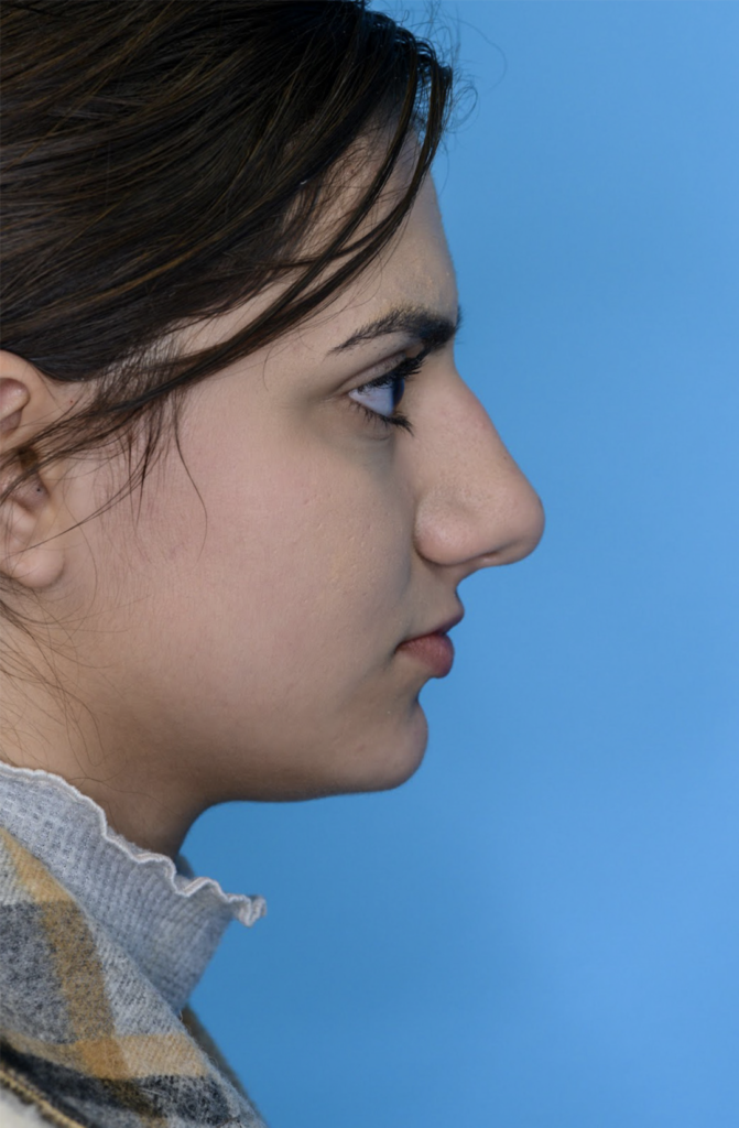 Patient KA's right lateral profile one year after rhinoplasty