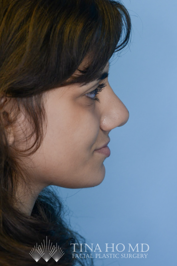 Patient KA's right lateral profile one year after rhinoplasty, alternate view